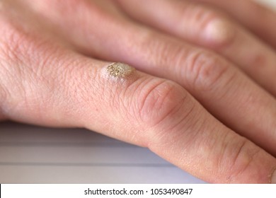 Wart on the hand finger. 