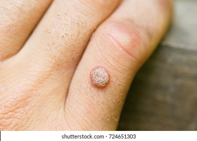 Wart on hand skin. Wart treatment finger. Warts treatment on fingers