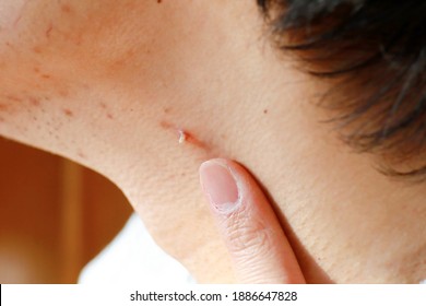 papillomavirus on neck)
