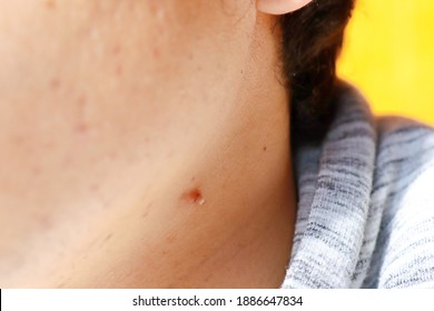 Wart virus on neck, Hpv on neck wart
