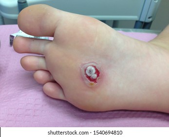 Wart on Sole of Foot