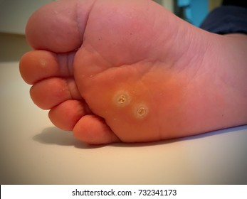 Verruca vulgaris foot treatment. Wart on foot verrucas