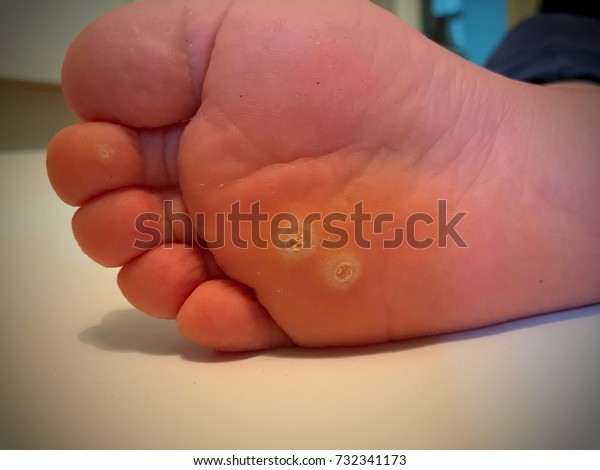 Papilloma wart on foot. How to Prevent & Treat Plantar Warts - Foot Care cancer de piele obraz