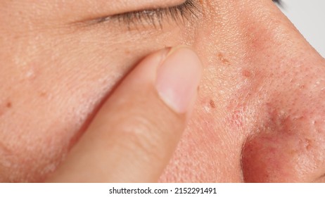 Wart skin removal. Macro shot of warts near eye on face. Papilloma on skin around eye nose and neck. Birthmark Papilla or mole on skin. small hard. benign growth on the skin caused by virus. Skincare