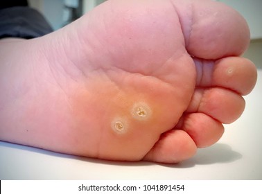 Wart verrucas plantar. Fasciitis Wart on foot. Decease on foot skin. Wart plantar callus foot . Warts plantar verruca foot
