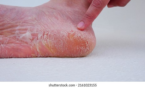 Wart Verrucas Plantar. Fasciitis Wart On Foot. Warts Plantar Verruca Foot