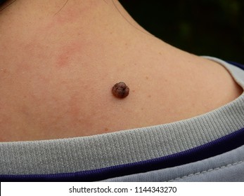 Warts Behind The Neck Of Asian Women