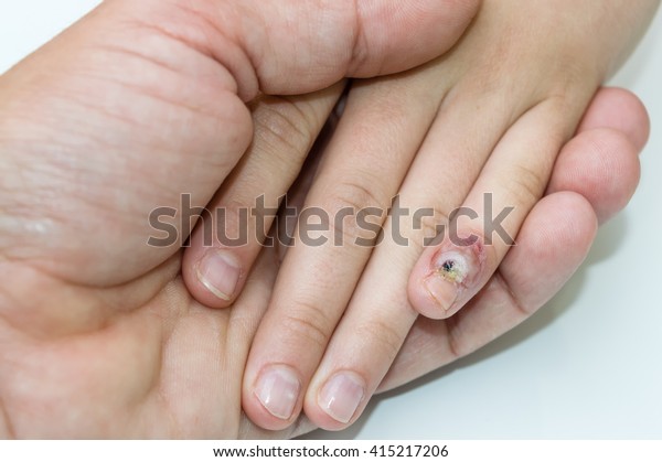 Papilloma finger. Wart treatment finger, Hpv finger warts treatment, Papilloma meaning in telugu