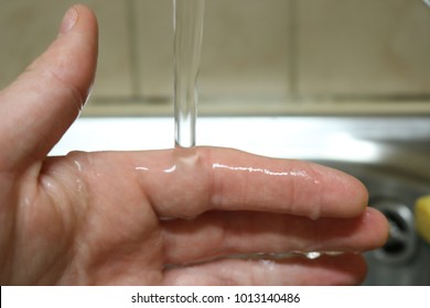 Washing Burn Hand With Water 