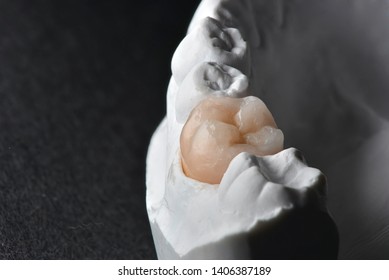 Wax Mandibular First Molar Stock Photo 1406387189 | Shutterstock