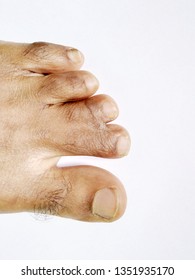 Webbed Toes Of A Person.