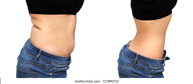 Weight Loss, Diet, Abdominoplasty.