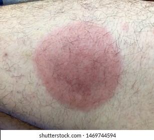 Well Defined Erythematous Round Patch At Posterior Part Of Left Thigh In Gentle Man Who Had History Of Tick Bite.