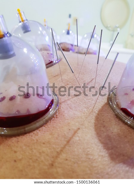 Wet Cupping Acupuncture Stock Photo Shutterstock