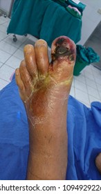 Wet Gangrene Left Big Toe 