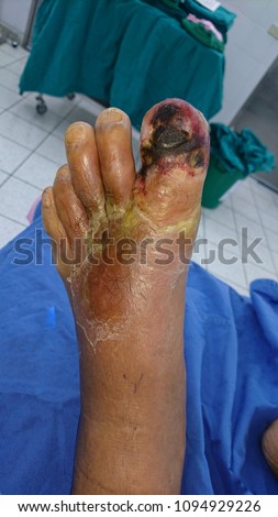 Wet gangrene left big toe 