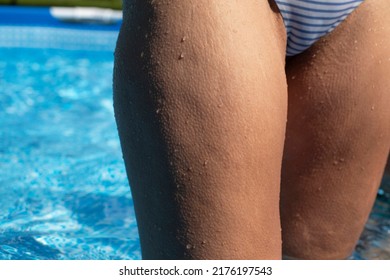 Wet Skin With Goose Bumps And Stretch Marks. Woman Legs With Goosebumps, Close Up