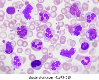 White blood cells in peripheral blood smear