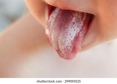 White coating on tongue baby. Oral thrush. 