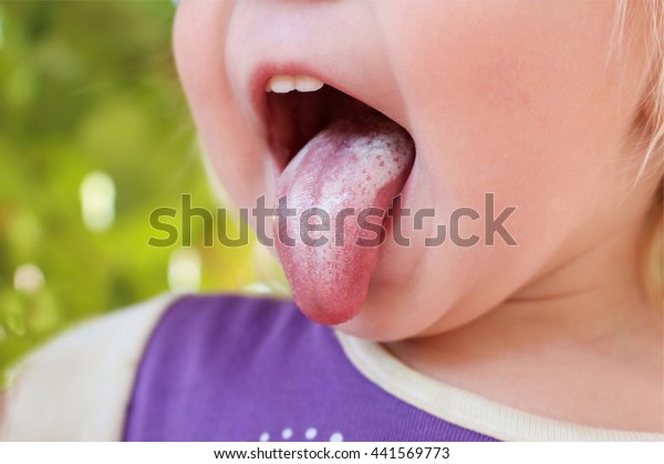 White Coating On Tongue Child Oral Stock Photo 441569773 Shutterstock