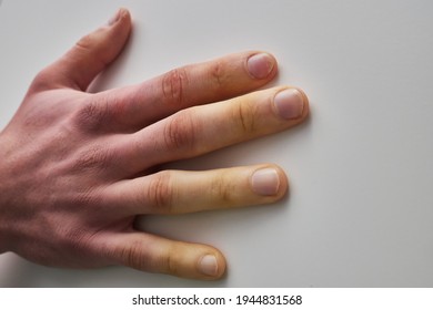 White Fingers From The Cold, Poor Blood Circulation