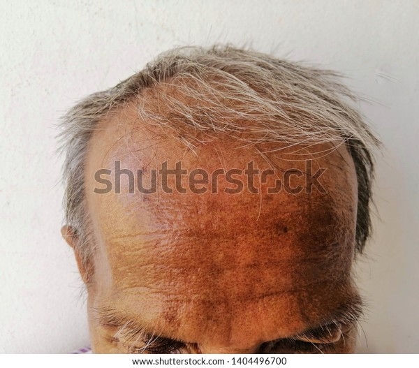 White Hair Bald Thin Hair Old Stock Image Download Now