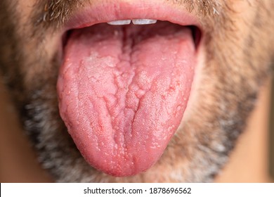 A White Male With Brown And White Facial Hair. Tongue Is Sticking Out To Show Geographic Tongue, Also Known As Benign Migratory Glossitis Where Lines Form And Can Cause Pain Or Discomfort.