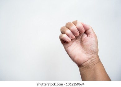 White Patches On The Palm And Fingertips, A Chronic Medical Condition With Skin Depigmentation - Vitiligo.