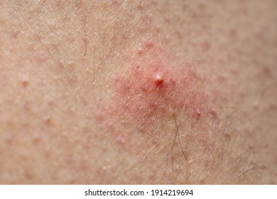 White Pimple On Human Skin In Macro Detail.