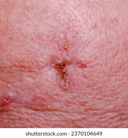 White skin cancer basalioma close-up - Shutterstock ID 2370104649