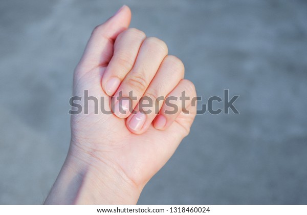 女性の指の爪の白い斑点が カルシウム欠乏による健康を明らかにした この病気は白爪病と呼ばれる の写真素材 今すぐ編集