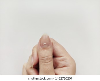 White Spots On Nail Isolated On White Background. Disease Leuconychia. Burr Nail. Nails Without Manicure. Right Hand