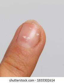 White Spots On The Nail Plate