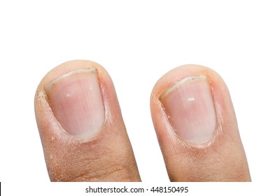 White Spots On Nails