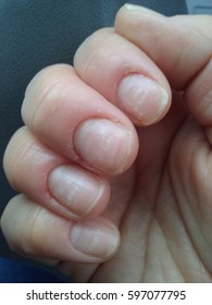 White Spots On Nails