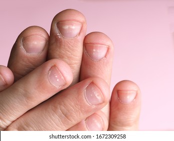 White Spots On Finger Nails Images Stock Photos Vectors Shutterstock