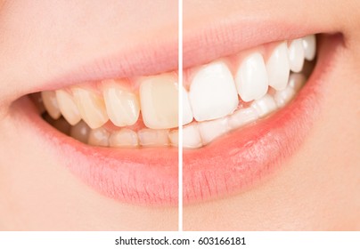 Whiten - a beautiful smile and teeth whitening treatment before and after.