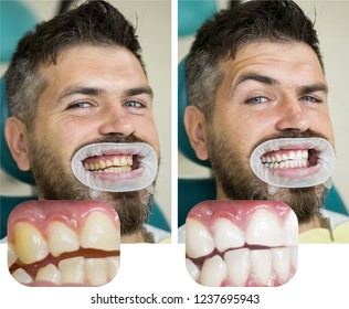 Whitening after and before. Man in dental chair. Dentist preparing for dental whitening. Health medicine people dentistry doctor curing. Result of teeth whitening