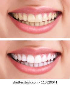 Whitening - Bleaching Treatment ,before And After ,woman Teeth And Smile, Close Up, Isolated On White