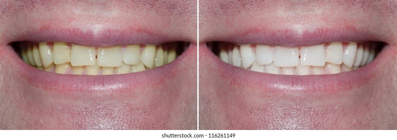 Whitening. Dental Care. Healthy Man White Teeth.