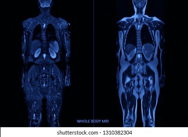 Whole Body MRI Scan Of Normal Human Body (High Resolution)