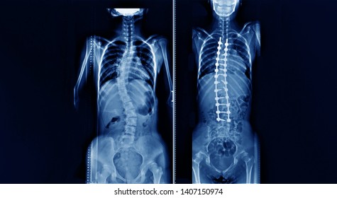 whole spine x-ray showing a patient with adolescent idiopathic scoliosis or AIS before and after correction deformity surgery. - Powered by Shutterstock