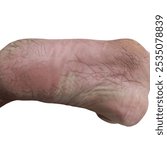 Why does the skin on the soles of the feet often crack?