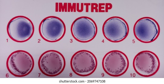 Widal Test By Agglutination Method At Plate Isolated On White Background, To Diagnosis Typhoid And Paratyphoid Fever At Laboratory, Salmonella Bacteria Disease Testing