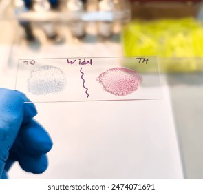 Widal test by agglutination method showing positive TO and TH result, Typhoid and Paratyphoid fever, salmonella