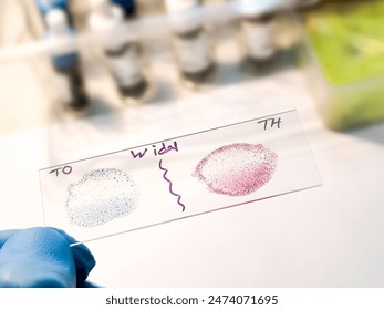 Widal test by agglutination method showing positive TO and TH result, Typhoid and Paratyphoid fever, salmonella
