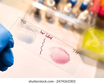 Widal test by agglutination method showing positive TO and TH result, Typhoid and Paratyphoid fever, salmonella