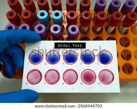 Widal test by agglutination method at plate isolated on white background. To diagnosis Typhoid and Paratyphoid fever at medical laboratory. Salmonella bacteria disease testing
