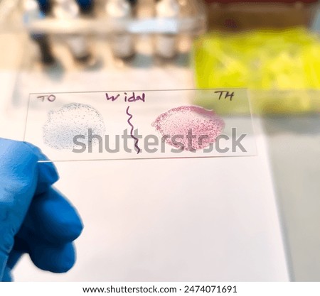 Widal test by agglutination method showing positive TO and TH result, Typhoid and Paratyphoid fever, salmonella