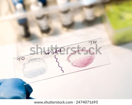 Widal test by agglutination method showing positive TO and TH result, Typhoid and Paratyphoid fever, salmonella